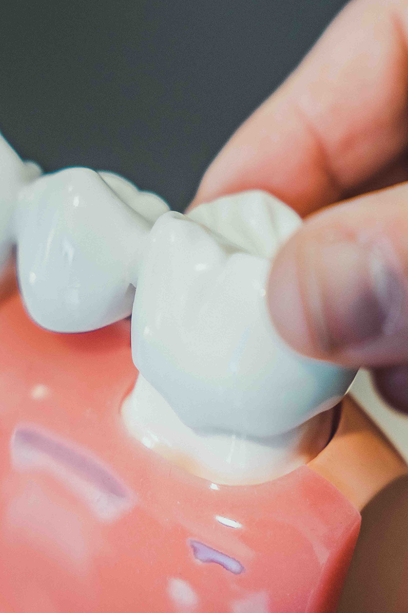 Estructures amb múltiples implants