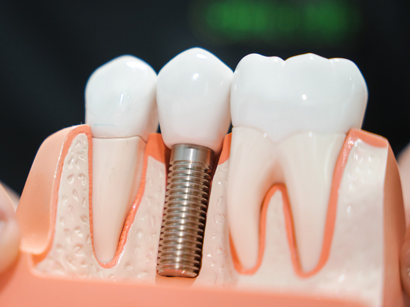 Implants unitaris