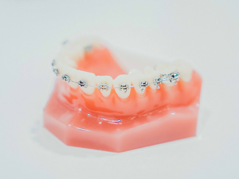 Ortodòncia amb brackets convencionals